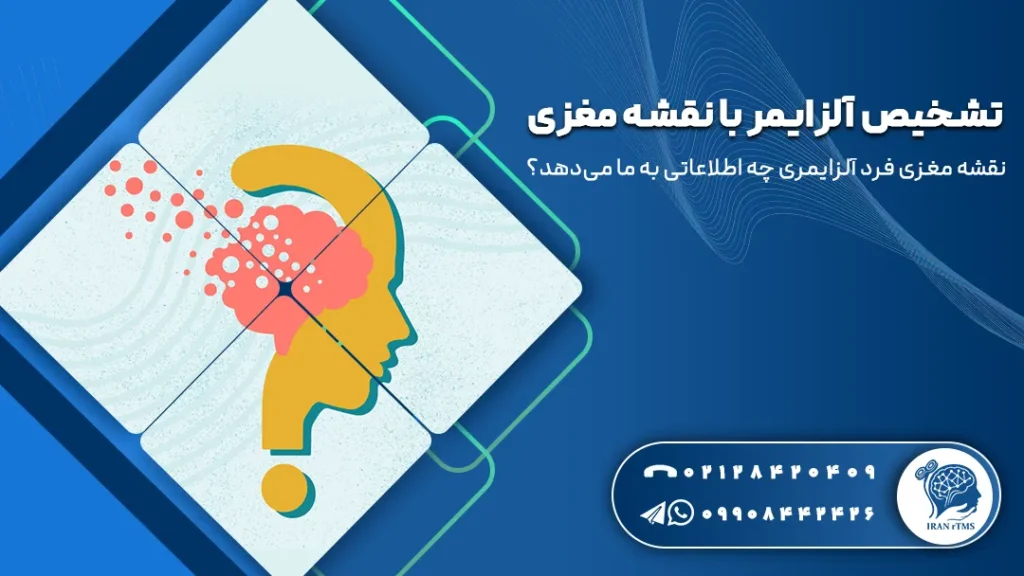 وکتور آلزایمر و تشخیص آلزایمر با نقشه مغزی