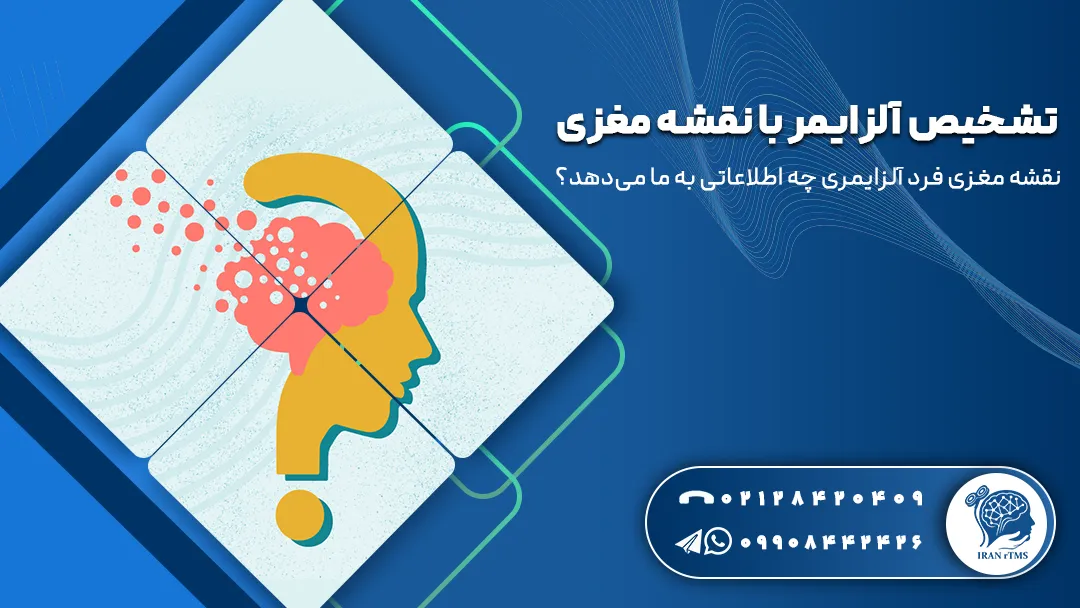 وکتور آلزایمر و تشخیص آلزایمر با نقشه مغزی